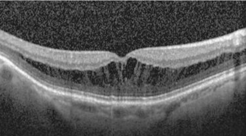 근시성 중심와분리증의 OCT 소견
