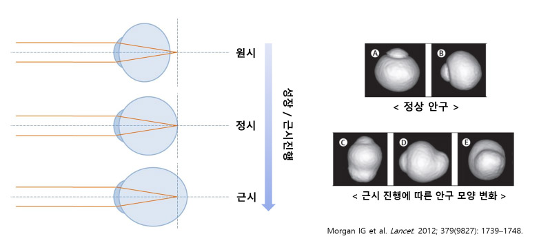 근시진행에따른안구변화